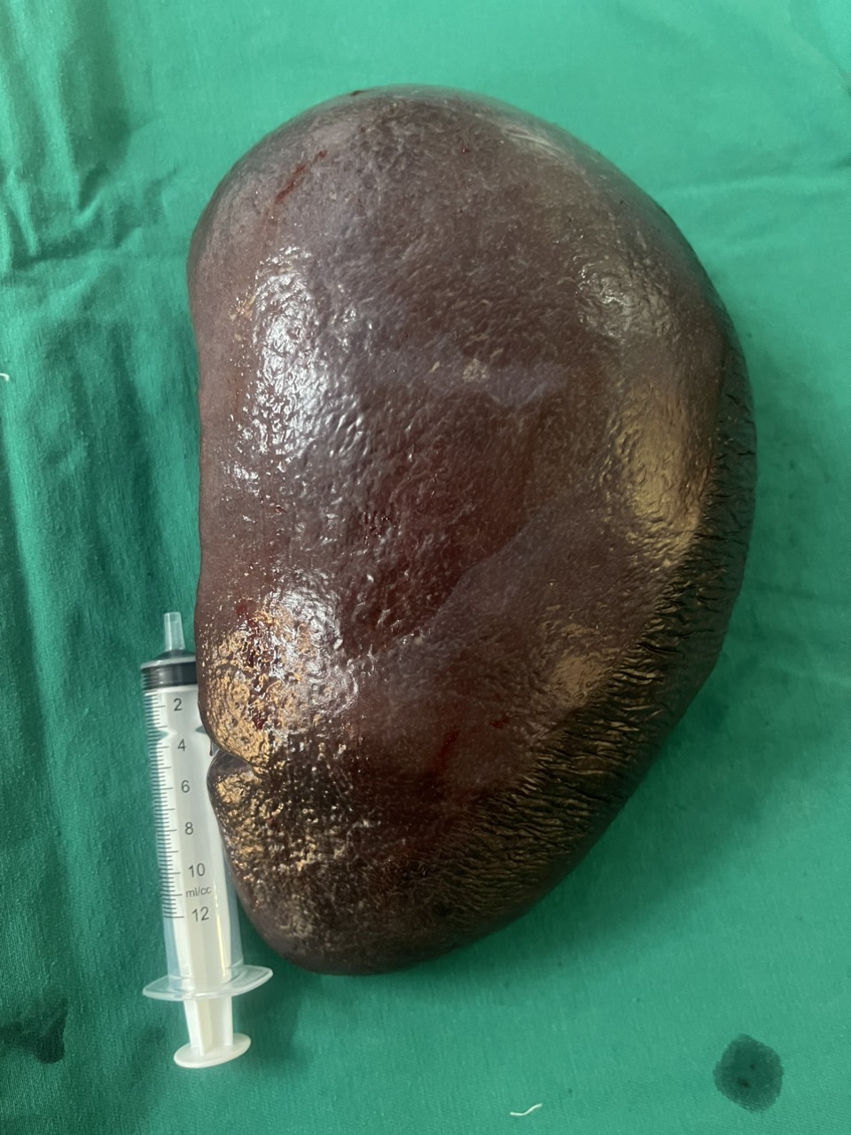 Hình ảnh tin tức Phẫu thuật cách Lách "khủng" 2kg cho bệnh nhi 12 tuổi