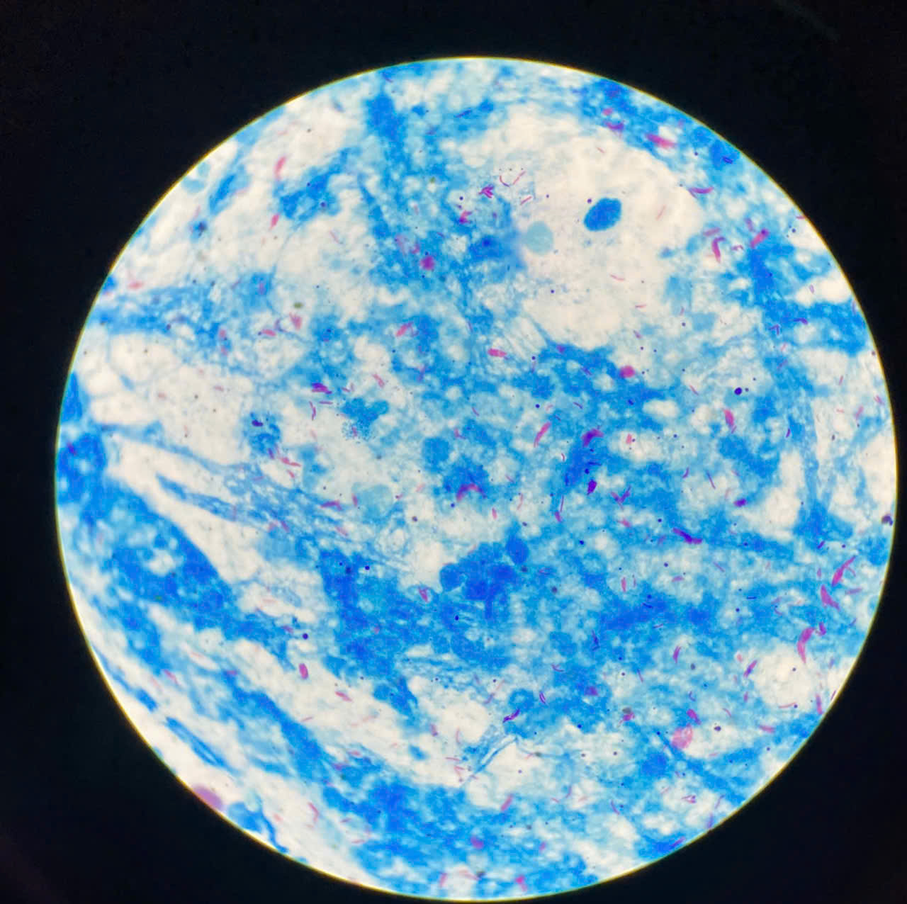 Hình ảnh tin tức BỆNH LAO – ĐỪNG CHỦ QUAN VỚI NHỮNG CƠN HO KÉO DÀI 